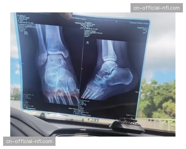 官方：尼斯后卫托迪博因脚踝韧带扭伤，预计缺席四周